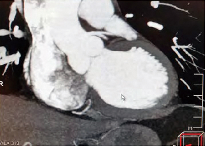 CT打顯影劑掃描心臟的動脈影像